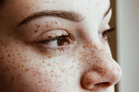 How To Get Rid Of Milia On Your Face — And Prevent Them