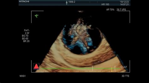 The Progression Of Gallbladder Mucoceles In A Dog By 3d4d Echo