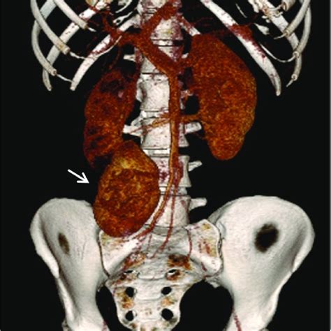Kidney On The Back Table Showing The Renal Vein V Main Renal Artery