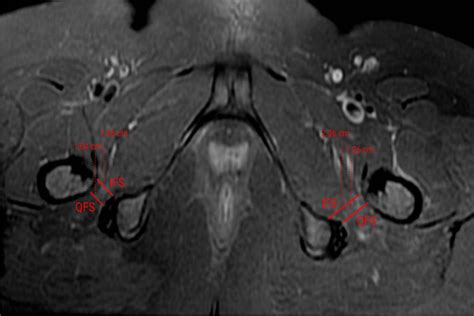 Axial T1w And Pdfs Mri Images Showing Reduction Of The Right