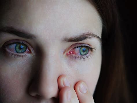 How To Get Rid Of Stoned Eyes Zinnia Health