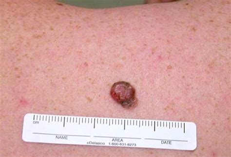 Mole Or Melanoma Test Yourself With These Suspicious Lesions