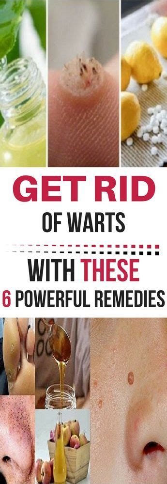 Get Rid Of Warts With These 6 Powerful Remedies Get Rid Of Warts