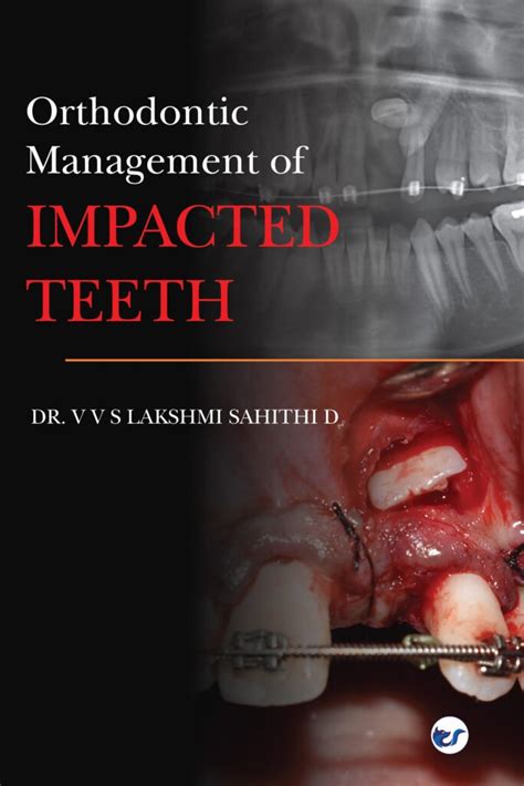 Orthodontic Management Of Impacted Teeth Clever Fox Publishing