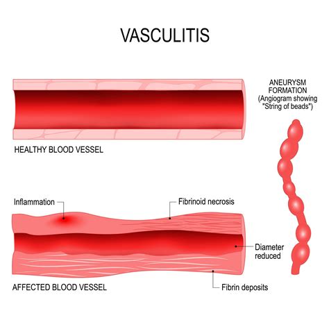 Vasculitis — Vascular Cures