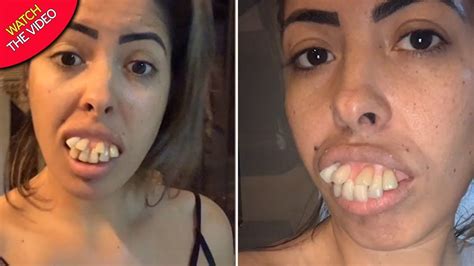 TikTok Woman S Teeth Transformation Gets Millions Of Views But Some