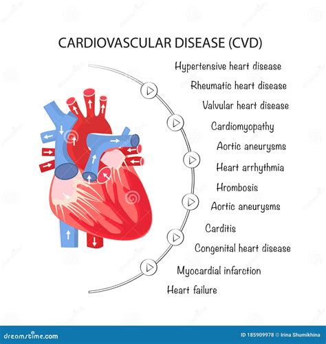 Types Of Cardiovascular Diseases On A Poster For Interns And Medical Institutions Vector