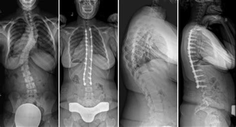 Before And After Examples Of Commonly Performed Scoliosis Surgeries