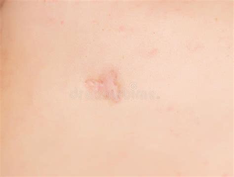 Scar On A Man`s Back After Removal Of An Inflamed Boil Scar Close Up