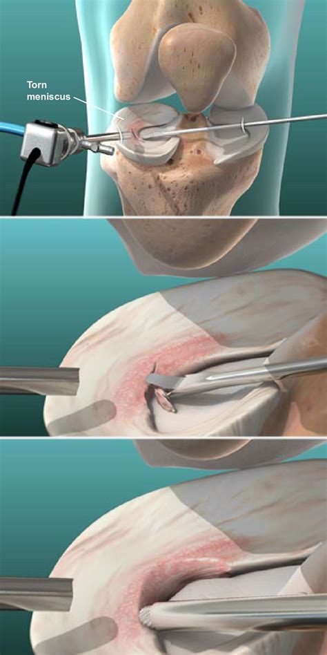 Arthroscopic Partial Medial Meniscectomy