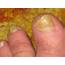 Zeta Clear & Toenail Fungus  Jeffs Ugly Toe