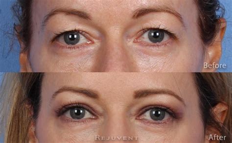 Upper Eyelid Surgery In Scottsdale • Rejuvent Medical Spa