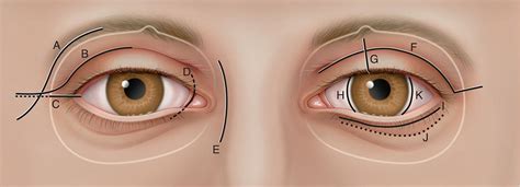 Orbital Surgery Ento Key