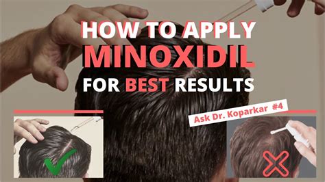 How To Apply Minoxidil For Best Results Ask Dr Koparkar Youtube