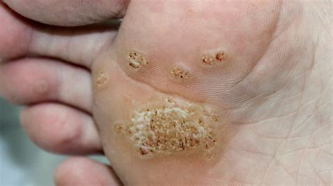 Warts In Babies Types Causes Treatment And Prevention