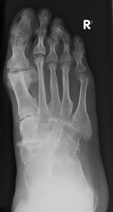 Rheumatoid Arthritis Foot The Podiatry Practice