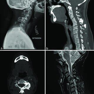 Preoperative Imaging A Lateral Plain Radiograph Showing Degenerative