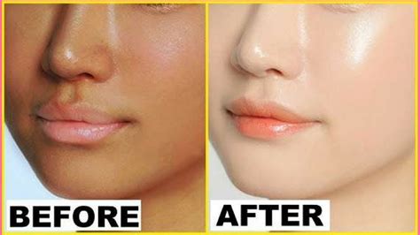 How To Reduce Acne Scars Discoloration Uneven Skin Tone I Home Remedy
