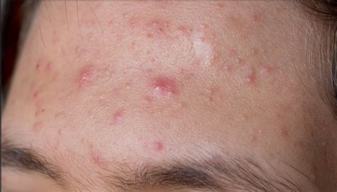 Folsom Ca Acne And Skin Care Clinic Experts Know Why Acne Attacks
