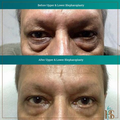 Blepharoplasty In Dubai Eyelid Surgery Dubai Dr Hasan