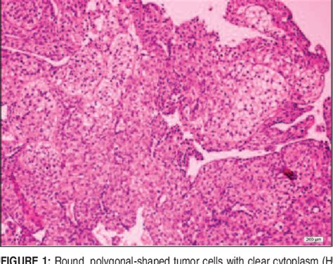 Figure 1 From Eyelid Nodular Hidradenoma Case Report Semantic Scholar