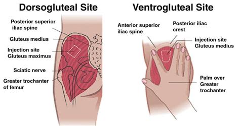 dorso vs ventro which glute injection is best for trt the trt hub