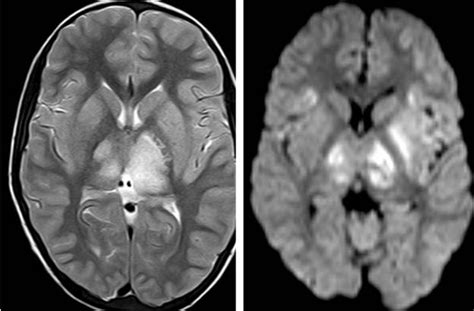 Abnormal Mri Brain Japanese Encephalitis Radiology Imaging