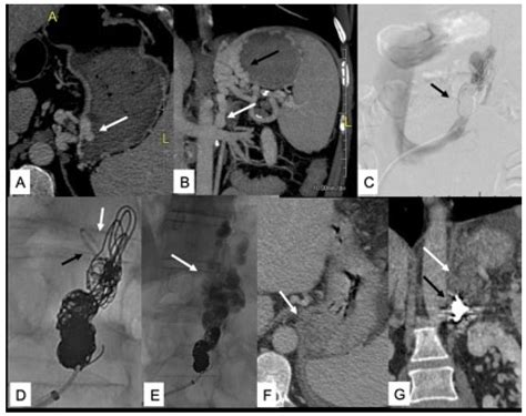 Jcm Free Full Text Cognitive Impairement In Non Cirrhotic Portal