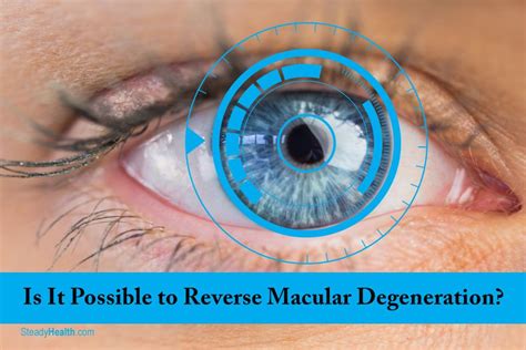 Is It Possible To Reverse Your Macular Degeneration Lasik Eye