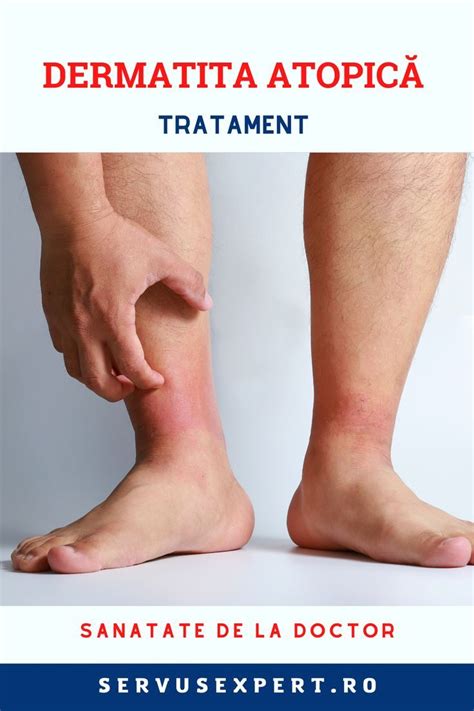Dermatita Atopica Sau Eczema Artofit
