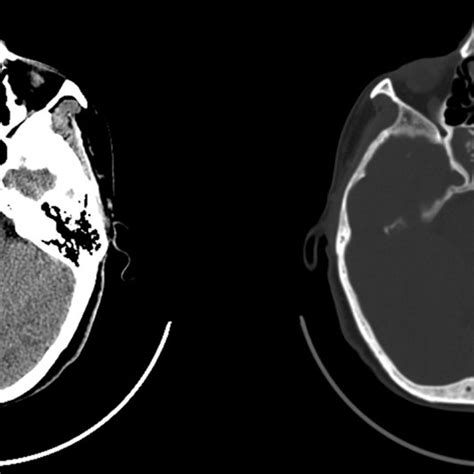 Axial Ct Image Shows Complete Opacification Of Right Sphenoid Sinus