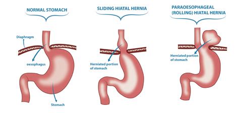 Hiatal Hernia Types Of Hernia Treatment Hernia Surgery In Perth