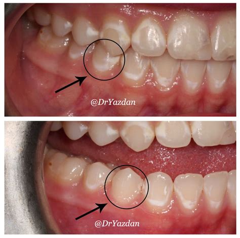 Icon White Spot Removal On Teeth Dr Desiree Yazdan Newport Beach