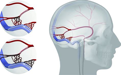 Endovascular Treatment Of Dural Arteriovenous Fistulas Of The