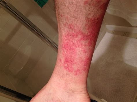 Bright Red Rash On Leg Above Ankle Video Bokep Ngentot