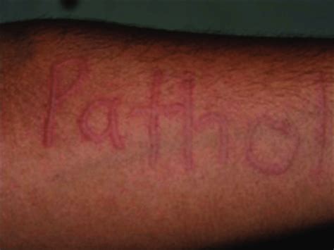 Dermographism Skin Writing A Writing Induced Patholgy Appeared As