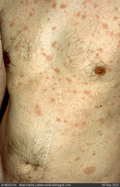 Stock Image Pityriasis Rosea With Multiple Red Scaly Patches Of