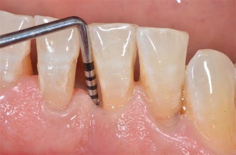 The Importance Of Periodontal Probing And Charting