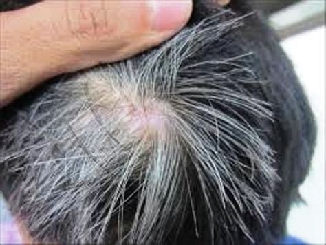 how does b12 deficiency causes hair loss and grey hair dermamantra