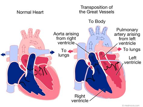 Transposition Of The Great Arteries Coronary Artery Anatomy