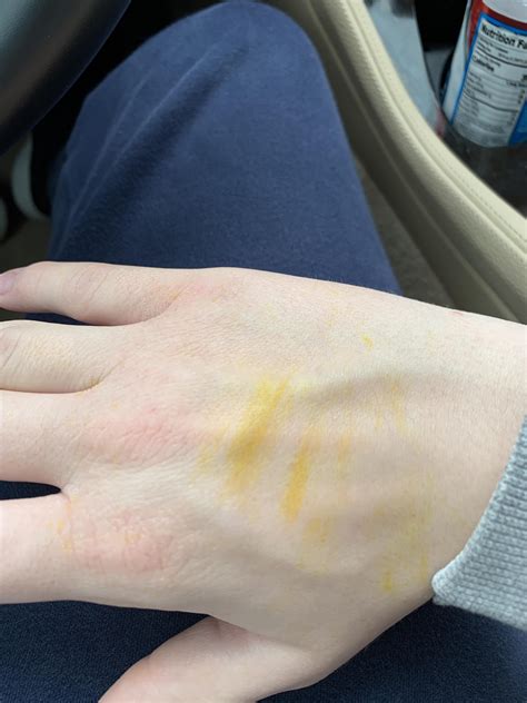 Yellow Skin On Hands