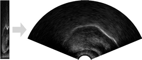 An Ultrasound Image Showing The Midsagittal View Of A Childs Tongue