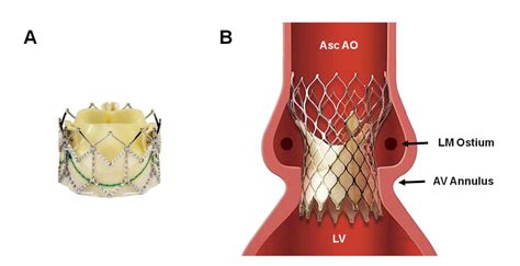 Two Most Commonly Used Transcatheter Valves For Tavr A Download
