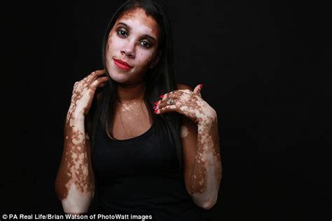 Virginia Woman With Vitiligo Now Makes Light Of Condition Daily Mail