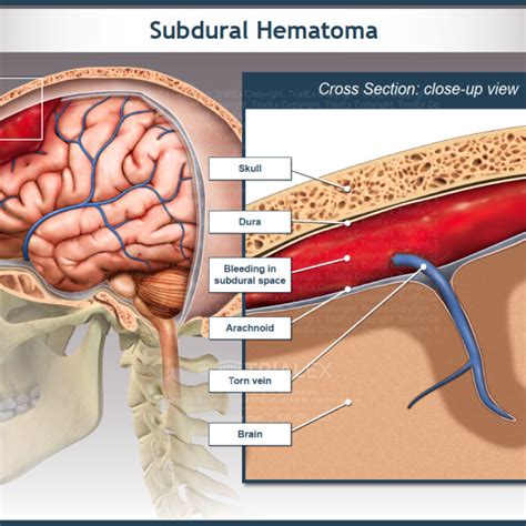 Subdural Hematoma Trialexhibits Inc