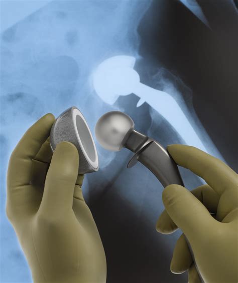 How a Hip Replacement Surgery Is Performed