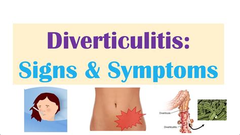 Neu Diagnosis And Management Of Acute Diverticulitis Systems Of