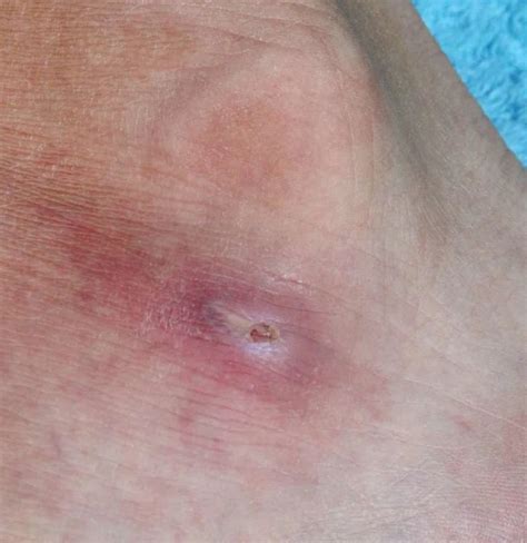 What Causes Red Spots On Feet Other Symptoms And Treatment 2022
