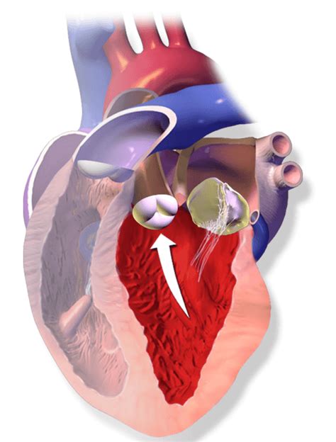 Aortic Stenosis Explained Pathology 101 For Patients