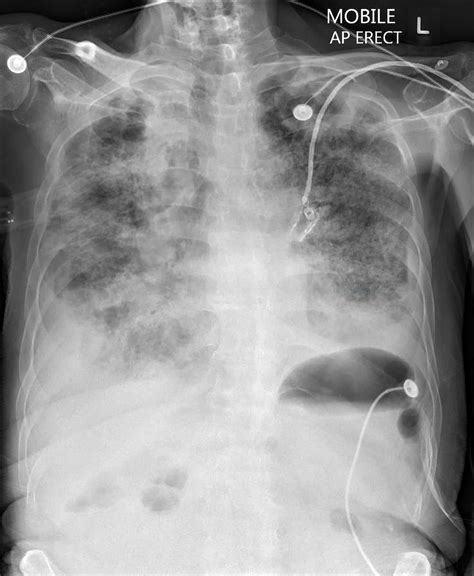 Pulmonary Nodules And Masses Chest X Ray Medschool